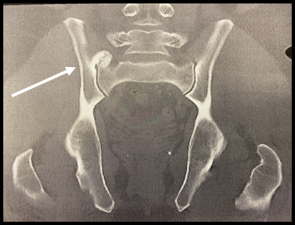 hip bone spur cat scan